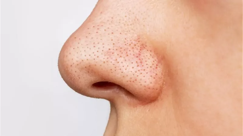7 نصائح تساعدك على منع ظهور الرؤوس السوداء