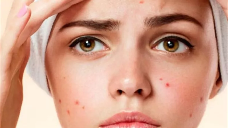أخصائية تجميل توضح اهم الأساطير المنتشرة عن حب الشباب