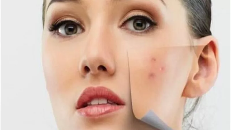 طرق علاج حب الشباب والرؤوس السوداء