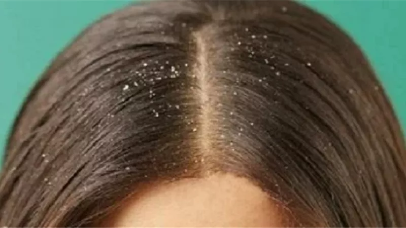 تعرف على طرق علاج صدفية الرأس وقشرة الشعر