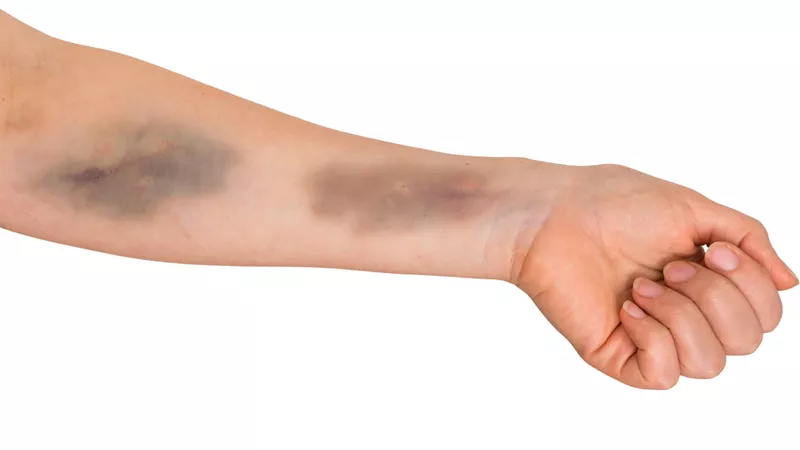 أسباب ظهور الكدمات عند كبار السن بسهولة