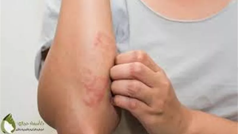 هل العوامل الوراثية احد اهم أسباب الإصابة بالأكزيما؟ طبيبة تجيب