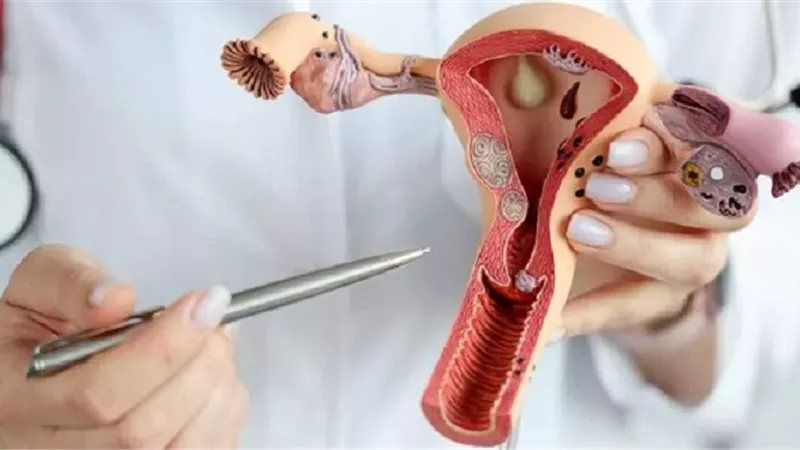 متلازمة تكيس المبايض .. الأسباب والعلاج