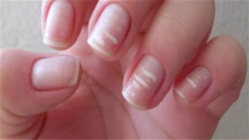خبيرة تحذر من ظهور هذه العلامات على أظافرك