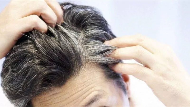 دراسة تكشف سبب الشيب قبل سن الثلاثين