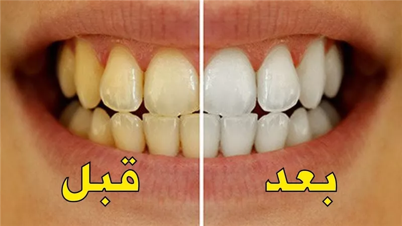 طرق منزلية لتبييض الأسنان