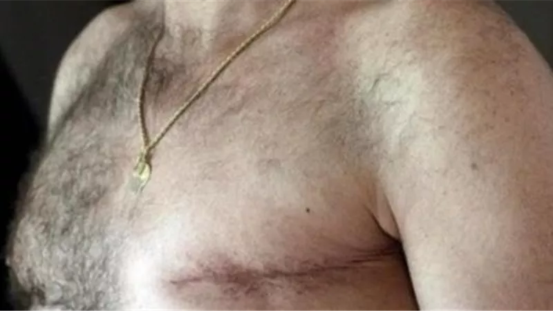 هل يصاب الرجال بسرطان الثدى وما هى الاعراض ؟