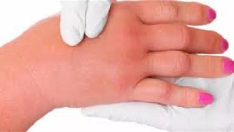 6 علامات تشير إلى احتباس السوائل في الجسم