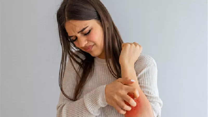 خبراء يكشفون كيفية التمييز بين الجرب والإكزيما