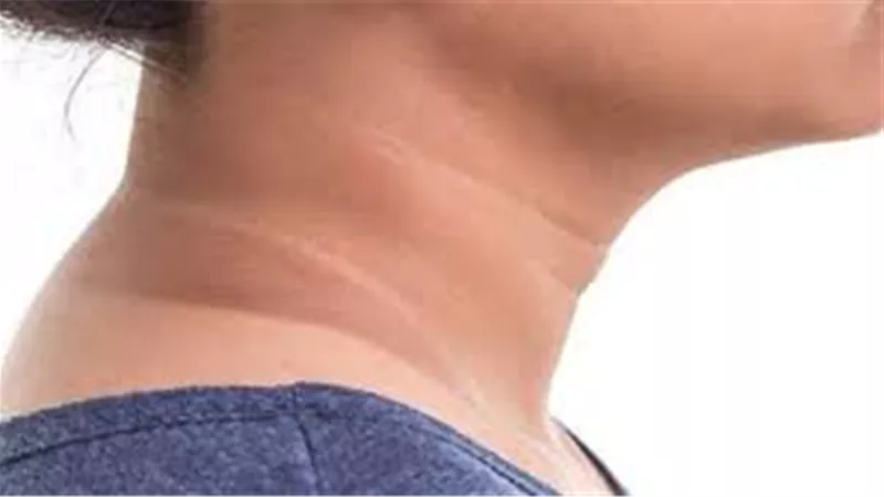 أعراض الإصابة بمقاومة الأنسولين وطرق العلاج