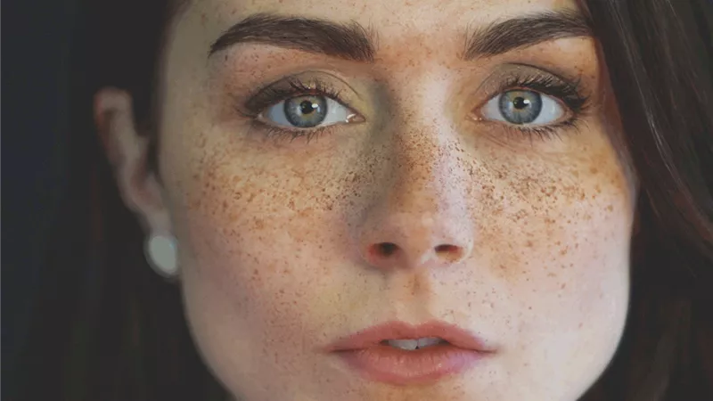 طرق علاج النمش