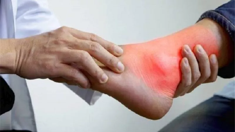 دراسة جديدة .. النقرس مرض مزمن له أساس وراثي