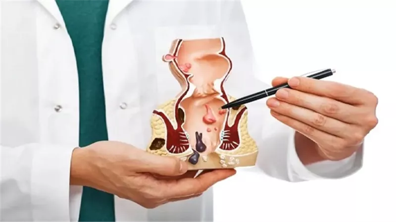 8 نصائح لعلاج البواسير في المنزل