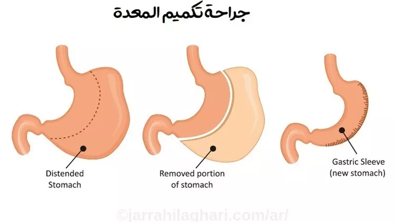 مميزات وعيوب تكميم المعدة