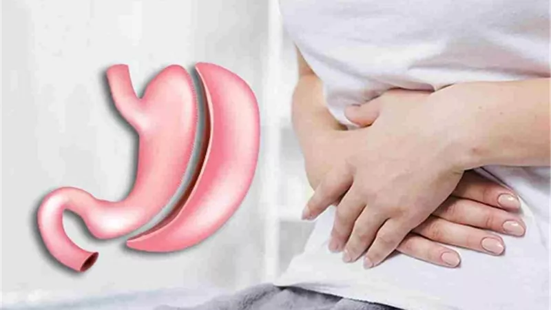 أضرار عمليات تكميم المعدة على المدى القريب والبعيد .. تعرف عليها