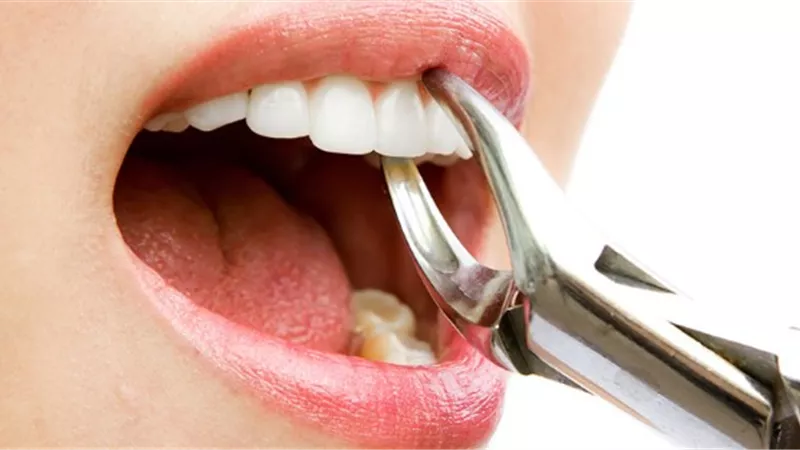 بيع الأسنان المخلوعة..حكمه يُبينه المفتي السابق