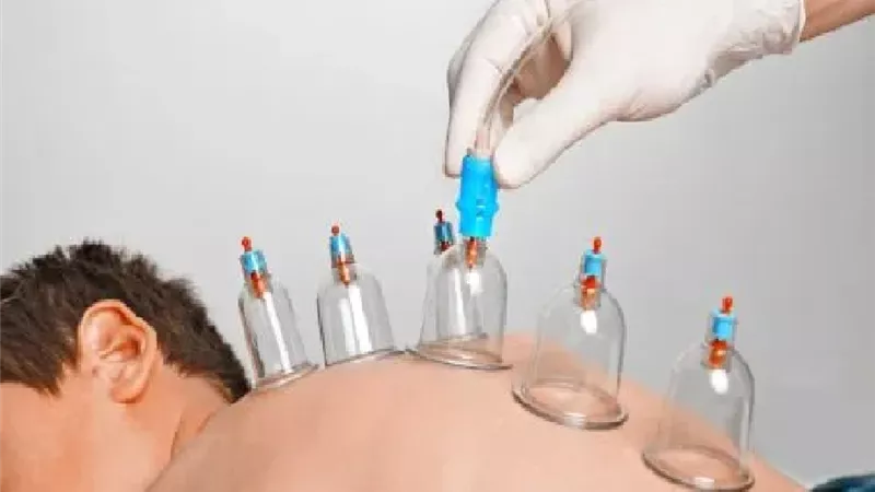 التداوي بالحجامة حكمه ومشروعيته