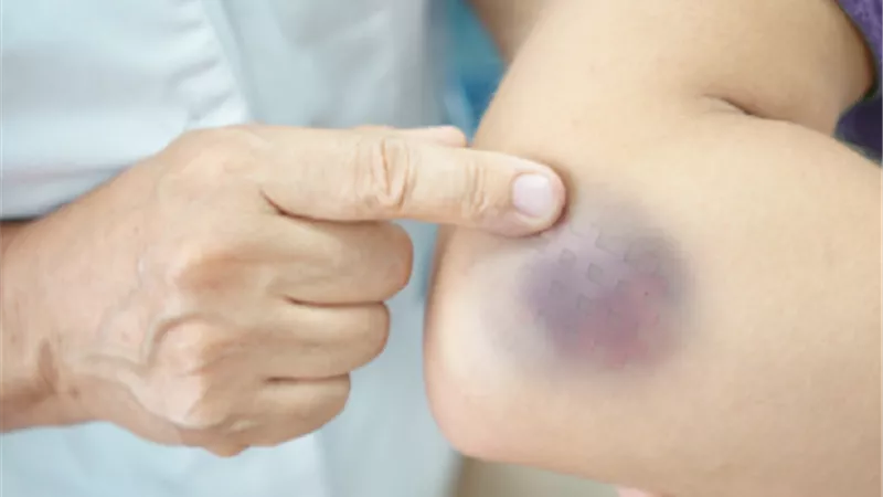 طرق علاج الكدمات بمختلف أنواعها