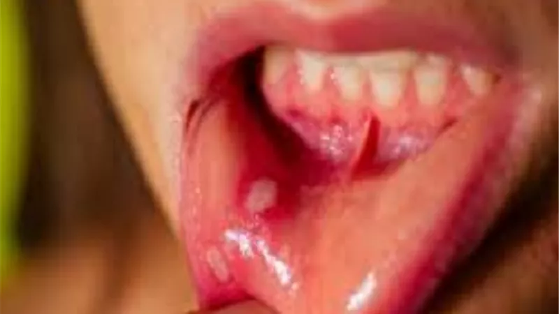 طرق طبيعية لتخفيف قرحة الفم المؤلمة