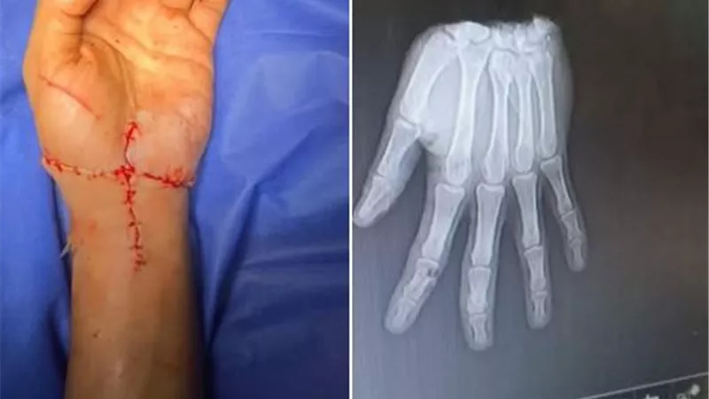 فريق طبى بقصر العينى ينجح في إعادة زراعة يد مبتوره بالكامل