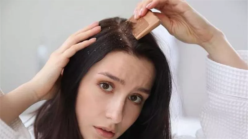 احذر .. عادات يومية تصيبك بقشرة الرأس في الشتاء