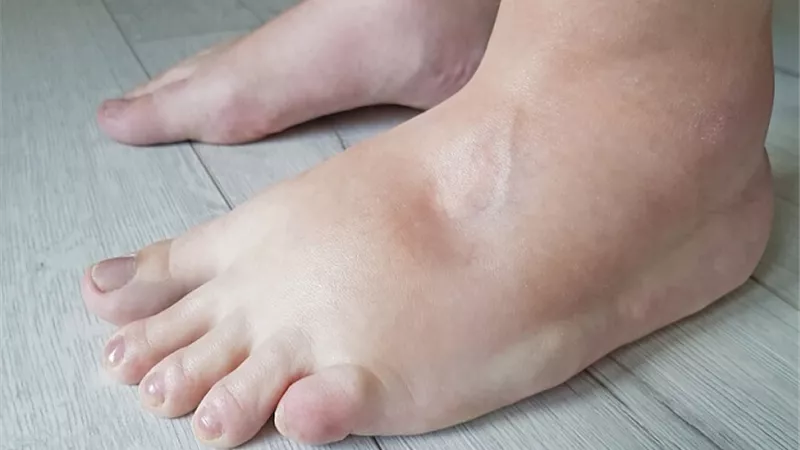 قصور القلب .. أبرز أسباب احتباس السوائل في الجسم