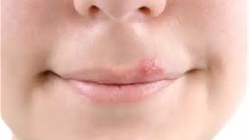 معلومات خاطئة حول مرض الهربس..احذرها