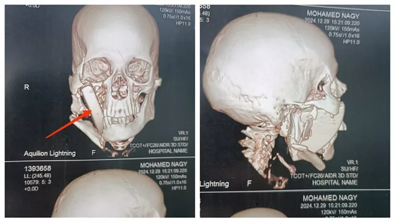 إزالة قطعة حجرية من وجه مريض بمستشفيات جامعة أسيوط