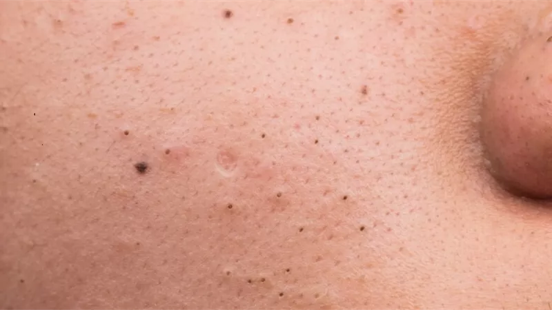 طرق التخلص من الرؤوس السوداء