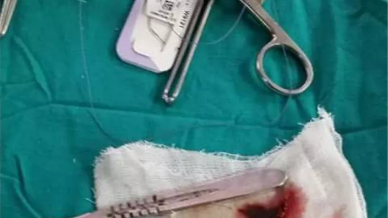 مستشفي سوهاج الجامعي يستخرج جسم زجاجي من صدر شاب