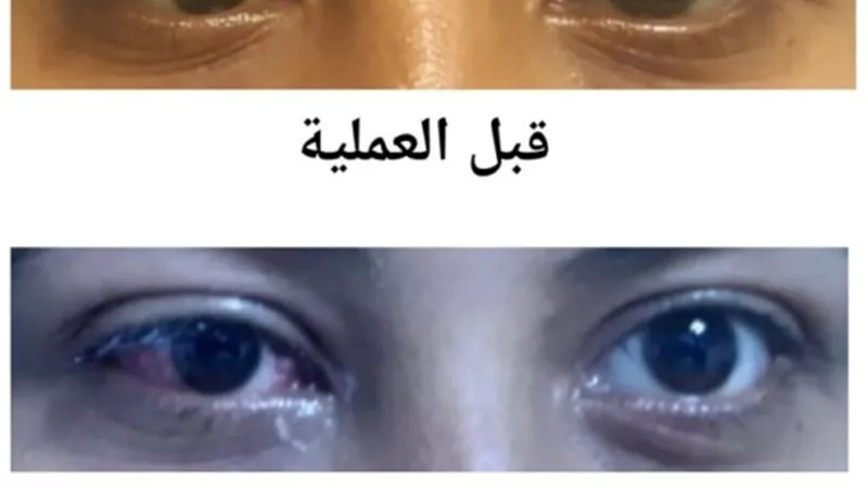 عمليتان جراحيتان لشفط الدهون وإصلاح حول بمستشفى الأقصر العام