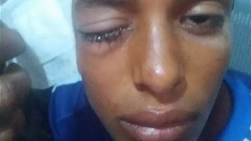 شاذلي فقد عينه اليمني ويطالب بعلاجه قبل ان يفقد اليسري