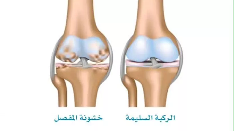 ٧ عوامل تهددك بخشونة الركبة .. احذريها
