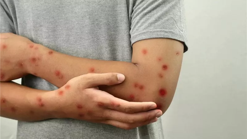 حصيلة صادمة لتفشي الحصبة في المغرب.. الحكومة تتحرك
