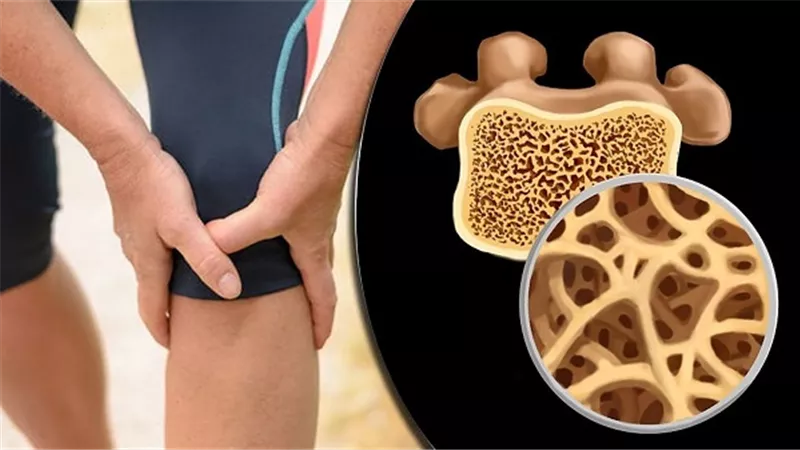 أعراض هشاشة العظام