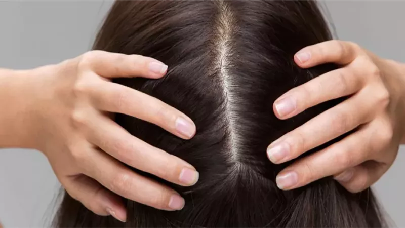 مكون بسيط في المطبخ يعالج مشكلات فروة الرأس