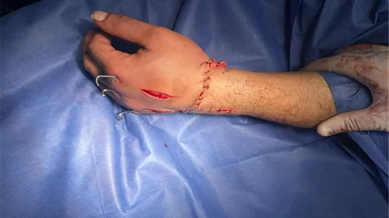 نجاح جراحة زراعة يد مبتورة لمريض بالقصر العيني