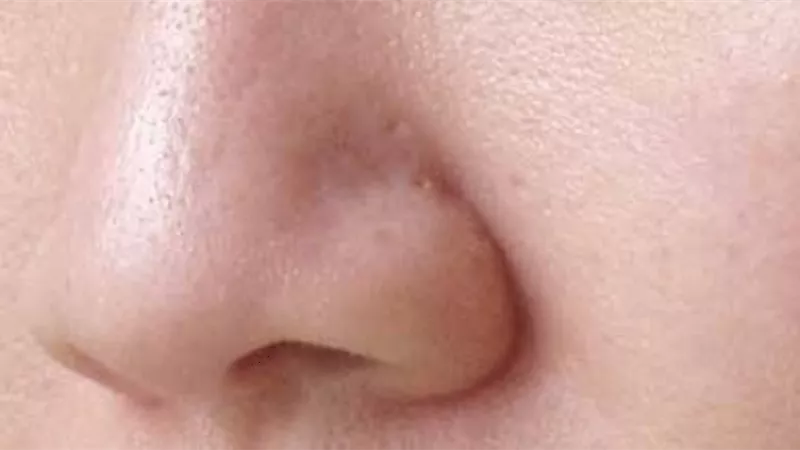 أسباب تؤدي لتقشر الأنف