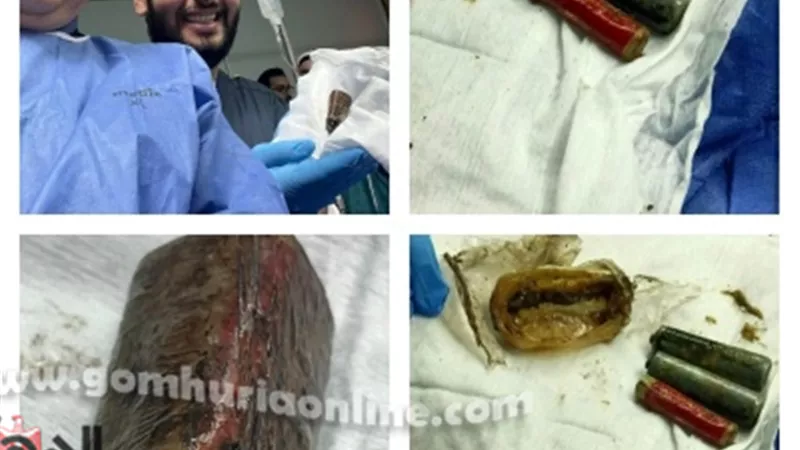 معجزة طبية بالمنوفية: استخراج حجارة ريموت من معدة مريض بدون جراحة