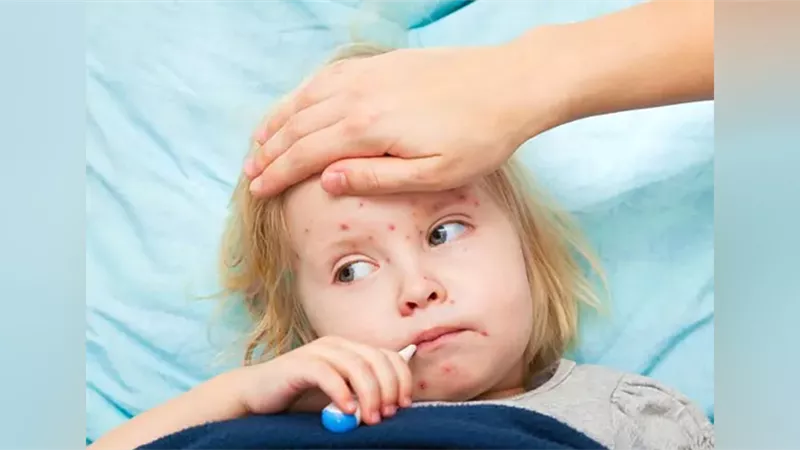 الحصبة تنتشر في 25 ولاية أمريكية والإصابات تتجاوز 700 حالة