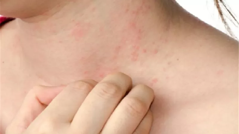 تعرف على اسباب وأعراض وعلاج الإكزيما