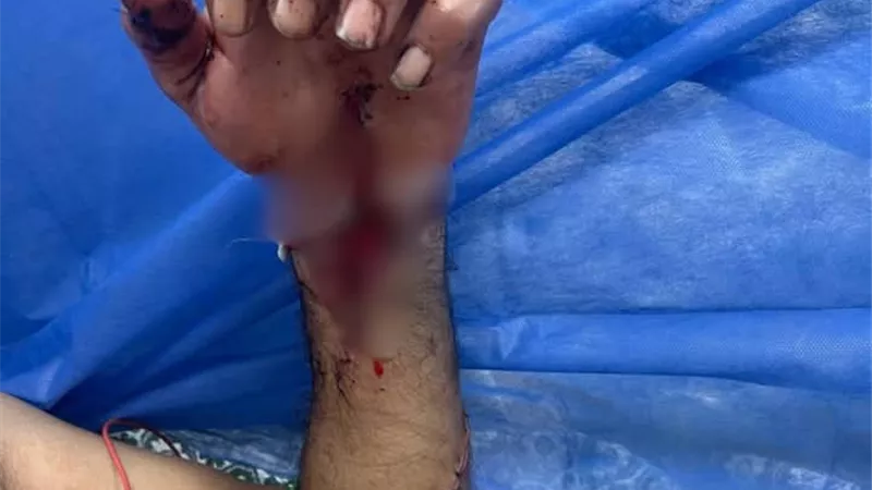إعادة توصيل ذراع مريض بعد بترها في مجمع السويس الطبي