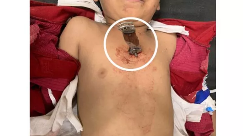 مستشفى جامعة سوهاج تنجح في إنقاذ طفل تعرض لطعنة نافذة بالقلب