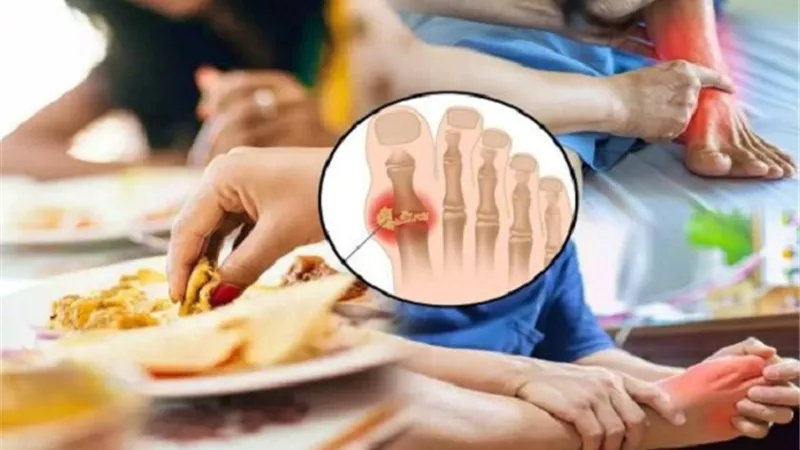 حمض اليوريك .. أطعمة ومشروبات تزيد من مخاطره