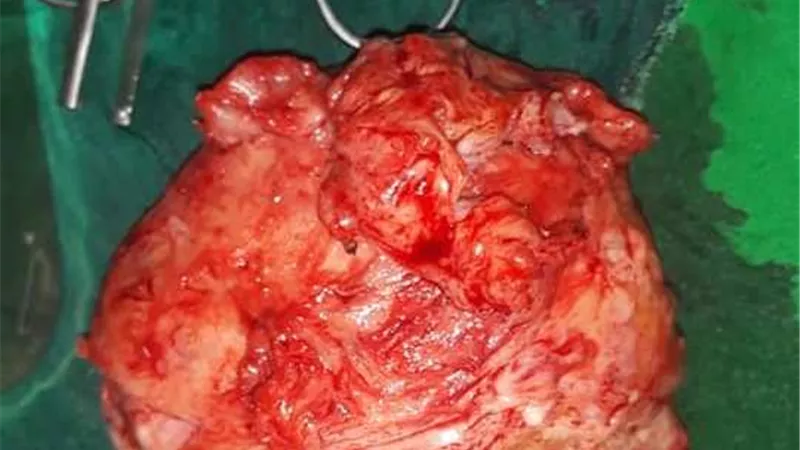 فريق طبي بمستشفي المراغة ينقذ مريضة ويستئصل ورما ليفيا