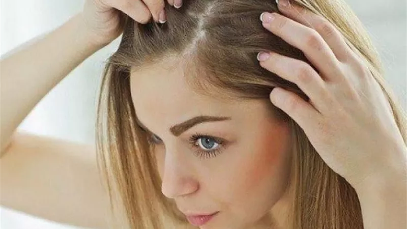 عادات يومية بسيطة للتخلص من قشرة الرأس