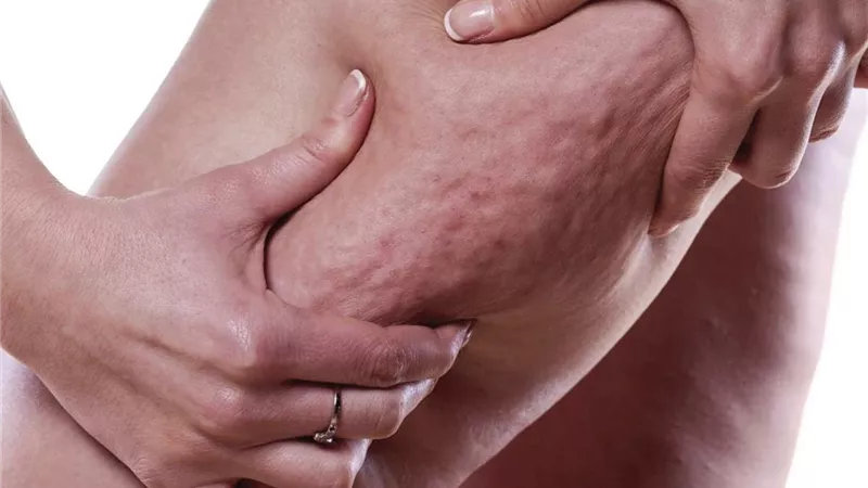 لماذا يحتبس الماء في جسمك؟ تعرف على أسباب 