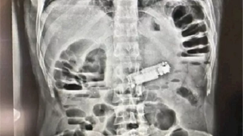 إنقاذ مريض في الغردقة بعد استخراج هاتف محمول من معدته