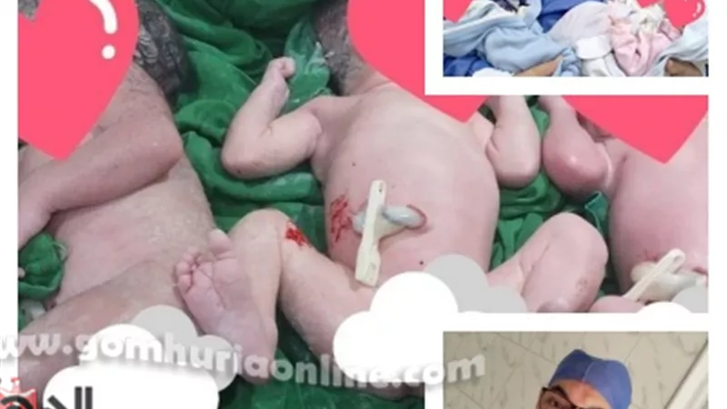 ولادة نادرة لتوأم ثلاثي بمستشفى قويسنا المركزي في المنوفية