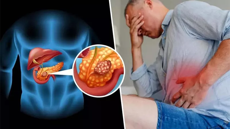 اكتشاف علاج لأكثر أنواع سرطان البنكرياس انتشاراً
